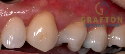 Gum Treatment After