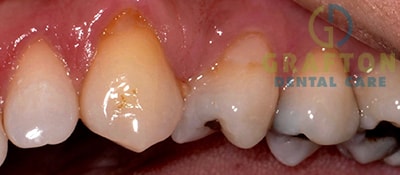 Gum Treatment Before