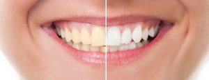 A before and after picture of a smile after teeth whitening in Grafton, MA.