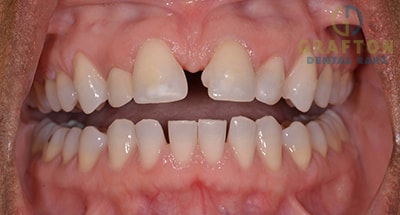 Invisalign Before