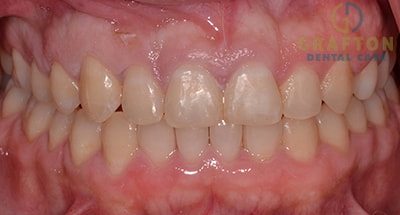 Clear aligner therapy After