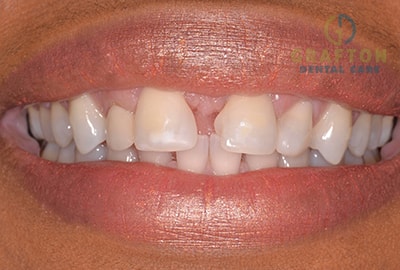 Invisalign Before