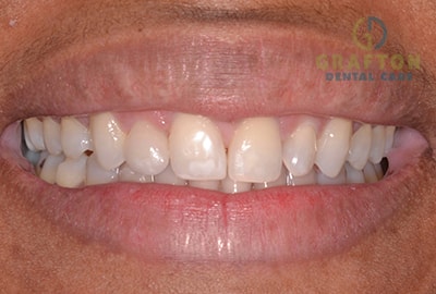 Clear aligner therapy After