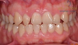A before and after picture of a smile after invisalign in Grafton, MA