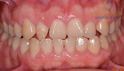 Clear aligner therapy Before