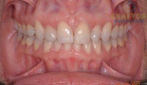 A before and after picture of a smile after invisalign