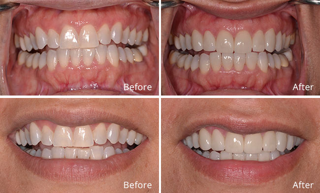 veneers before and after