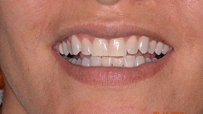 Porcelain Veneers Before