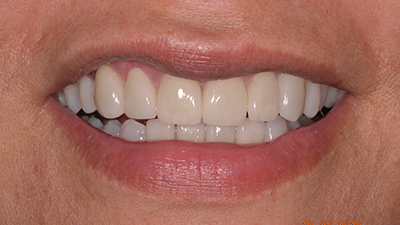 Porcelain Veneers After