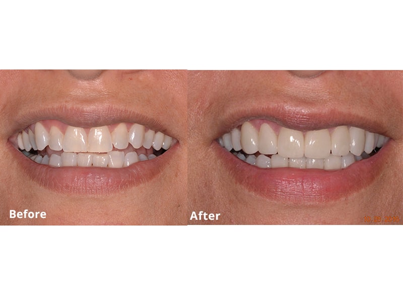 A before and after picture of a smile