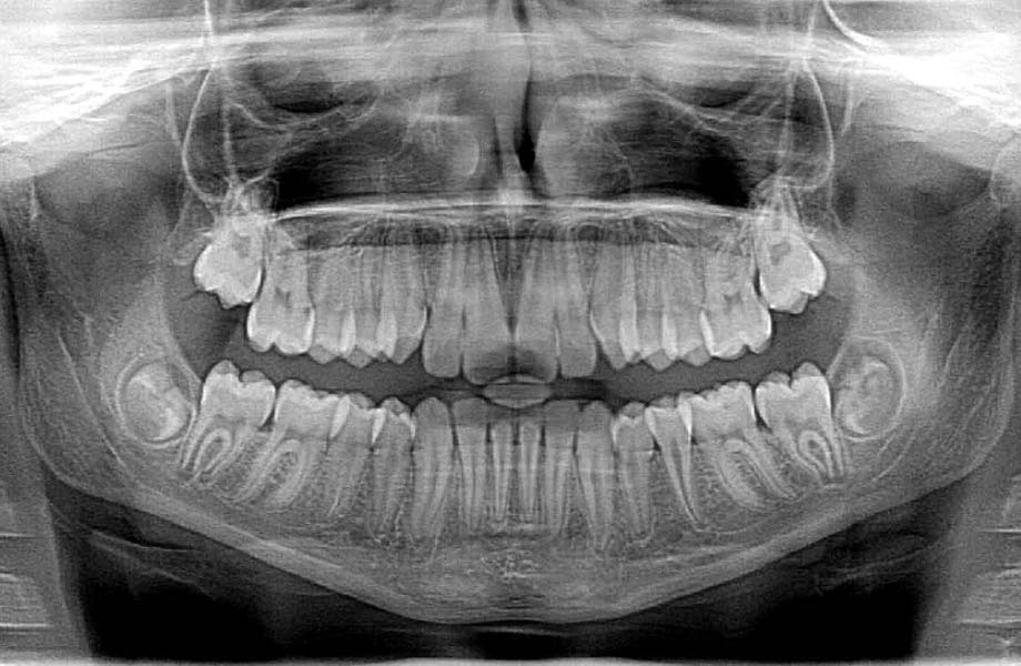 Dental X-ray of adult teeth showing full set of teeth and jawbone.