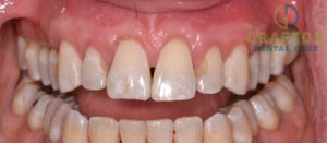 A before and after picture of a smile after gum treatment