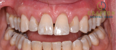 Gum Treatment After