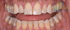 A before and after picture of a smile after gum treatment in Grafton, MA