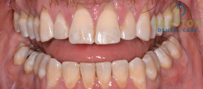 Gum Treatment Before