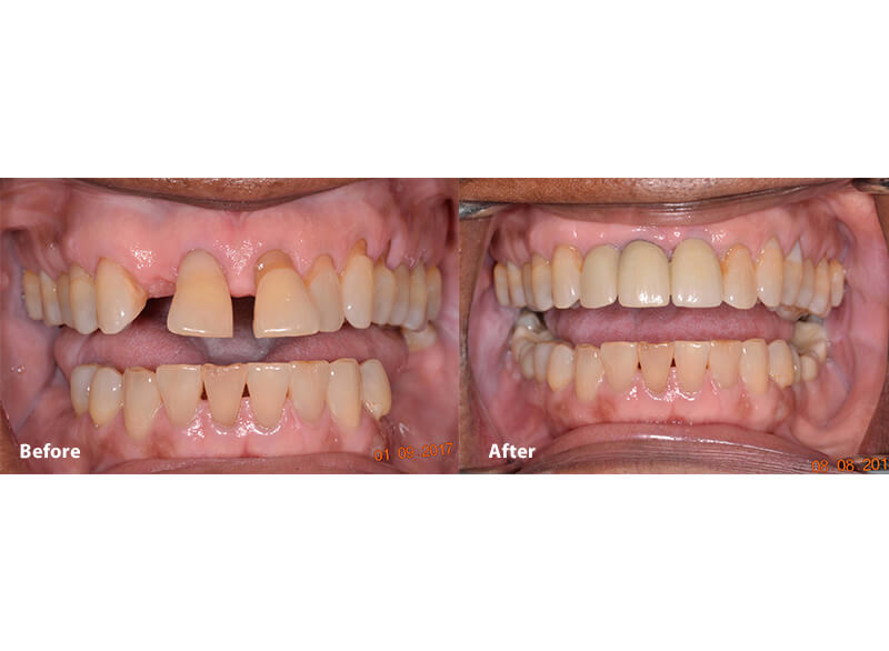 A before and after picture of a smile after dental implants