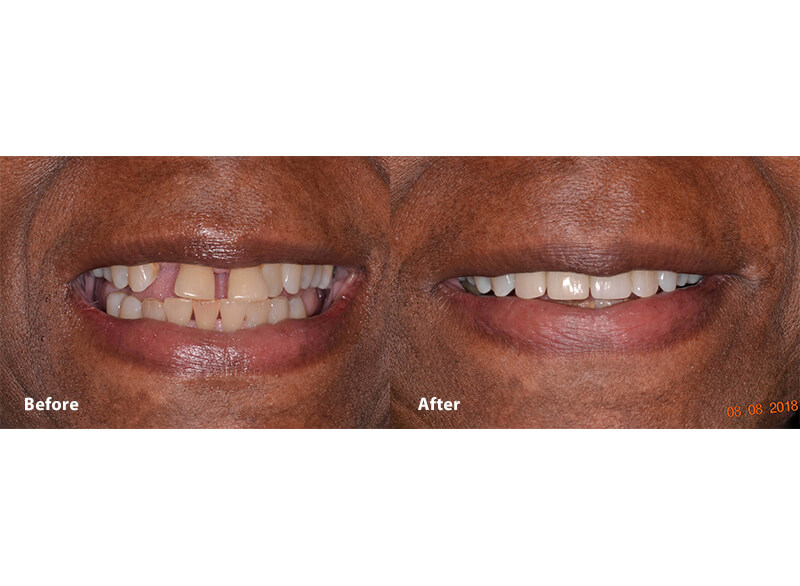 A before and after picture of a smile after dental implants in Grafton, MA