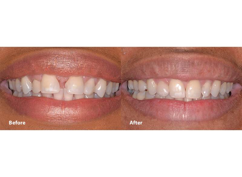 A before and after picture of a smile after invisalign