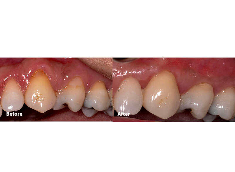 A before and after picture of a smile after pinhole surgery