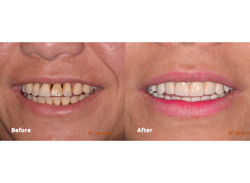A before and after picture of a smile after cosmetic work