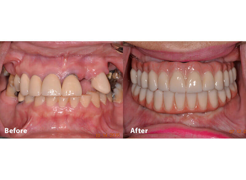 A before and after picture of a smile after orthodontics in Grafton, MA