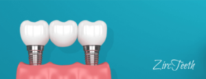 A 3D rendering of a three tooth zircteeth implant