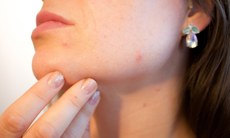 woman checking her face for acne caused by poor oral health 