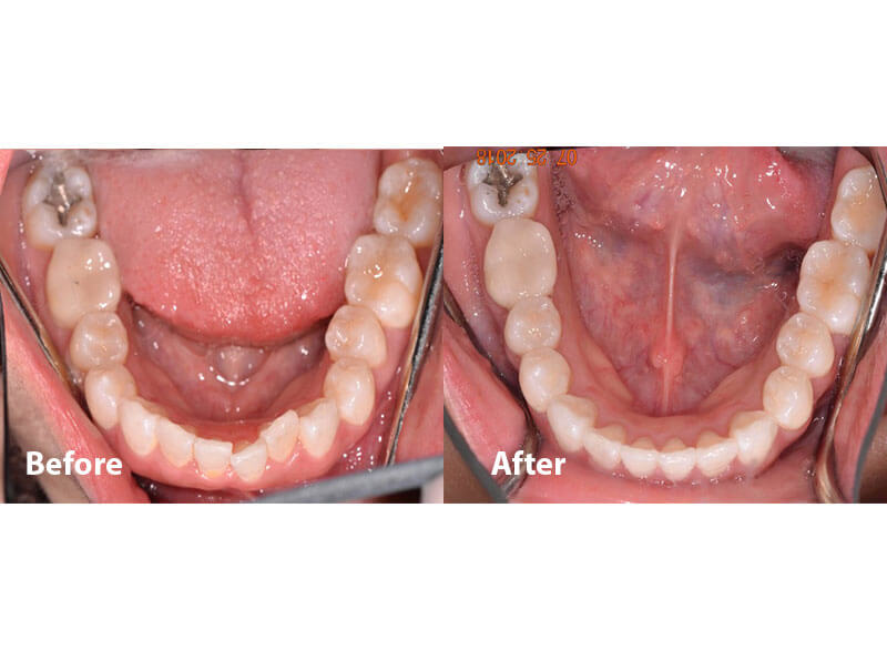A before and after picture of someone's lower jaw after orthodontics