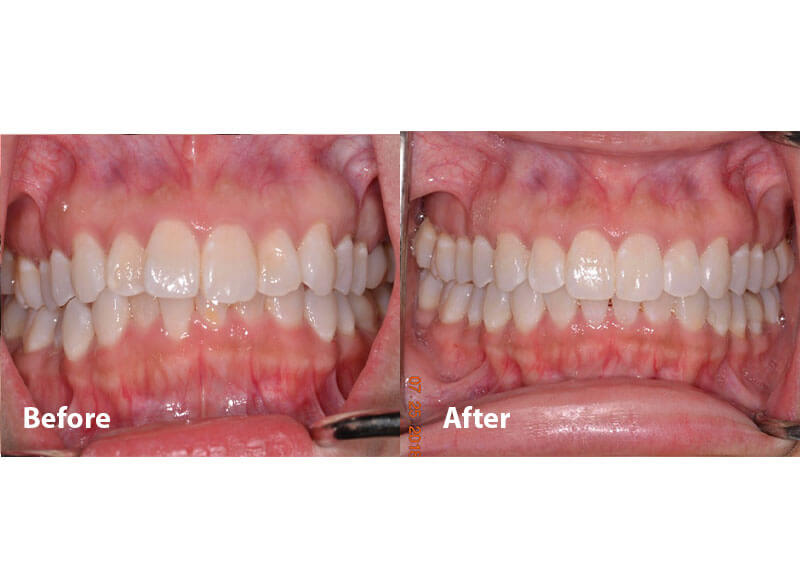 A before and after picture of an underbite fixed by orthodontics