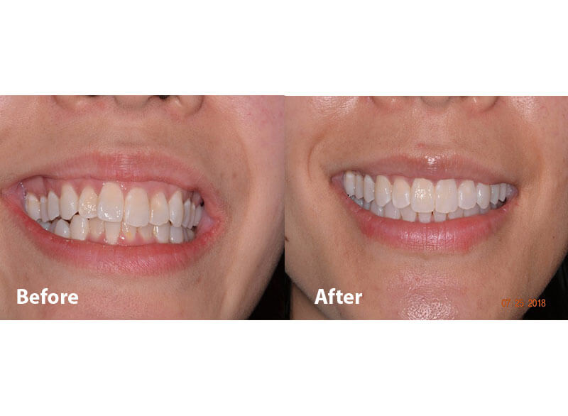 A before and after picture of a smile after orthodontics