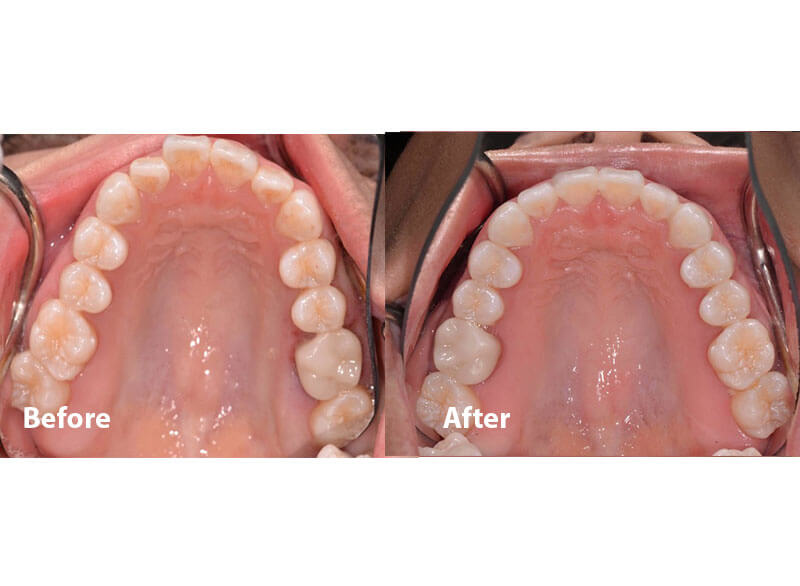 A before and after image of an upper jaw after orthodontics in Grafton, MA