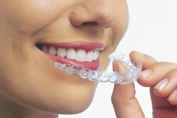 Invisalign: Straighten Your Teeth Discreetly