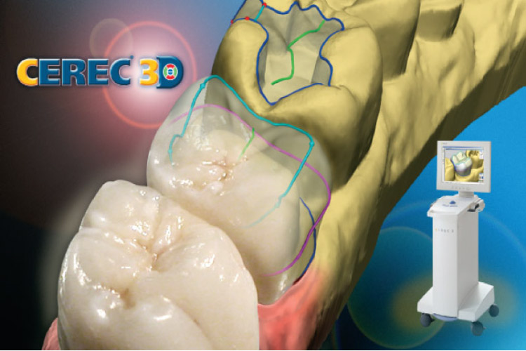 CEREC one visit dental crowns technology