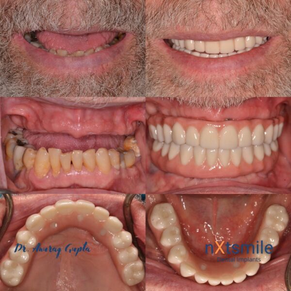 nxt smile before and after