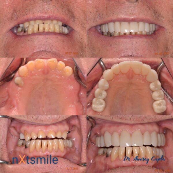 nxt smile before and after