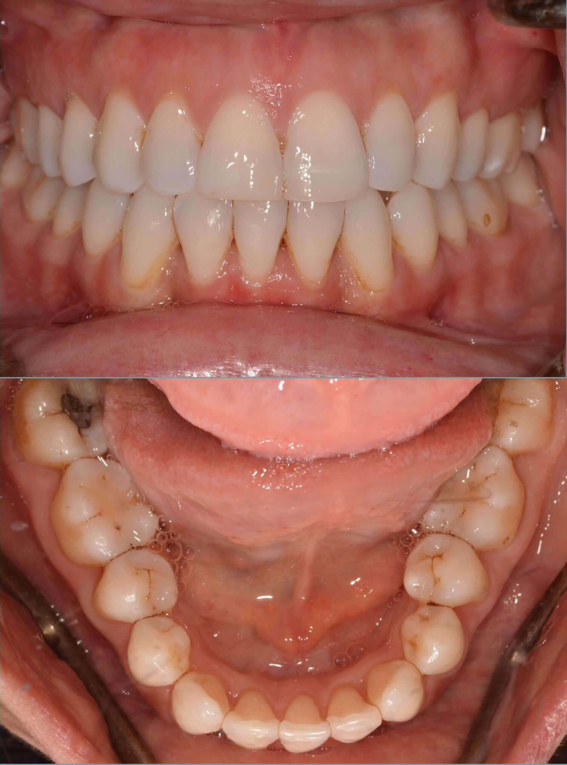 Clear aligner therapy After