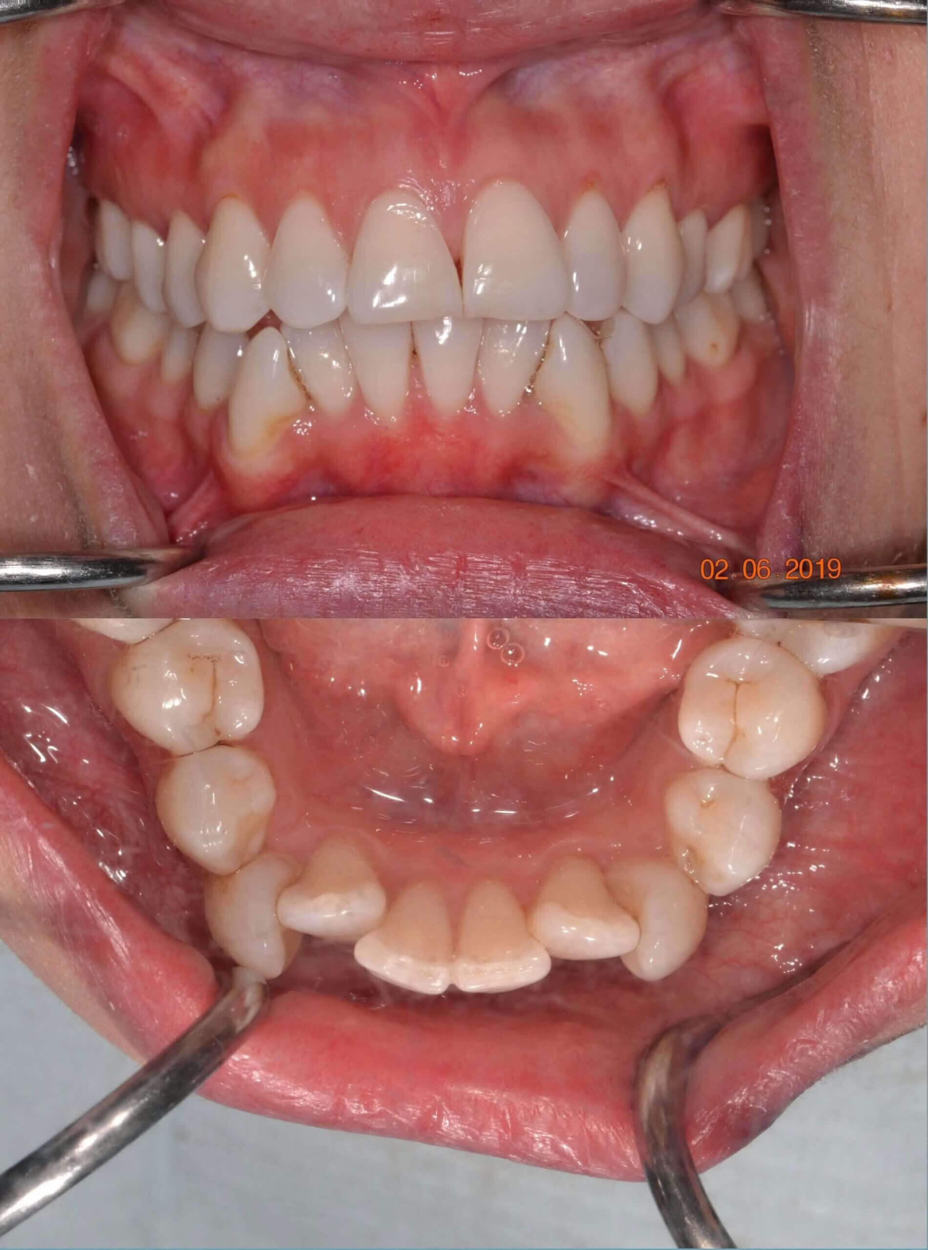 Clear aligner therapy Before