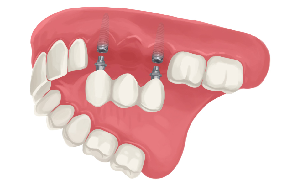 Drawing of an implant-supported bridge replacing missing teeth on an upper arch