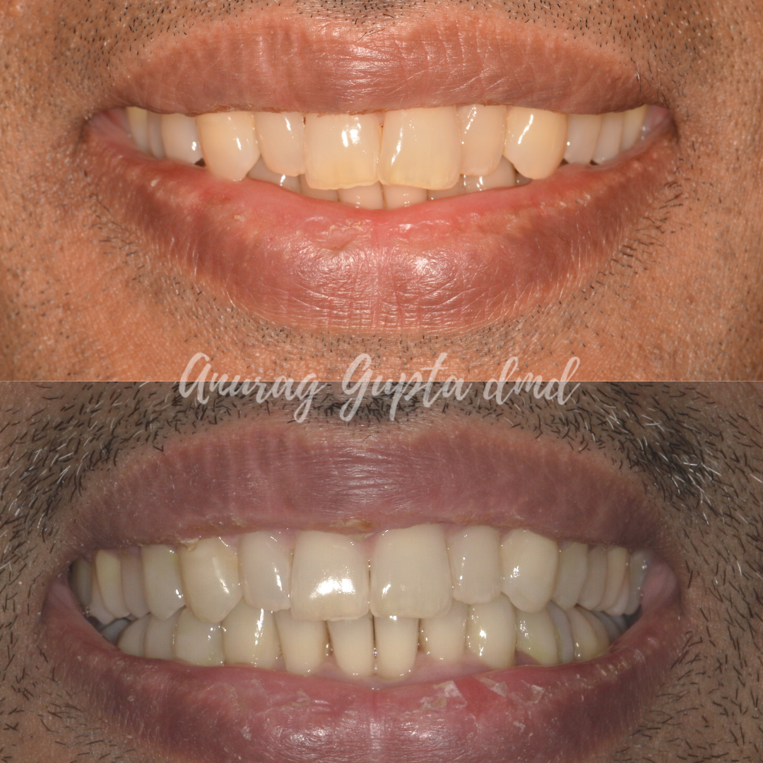 Clear aligner therapy