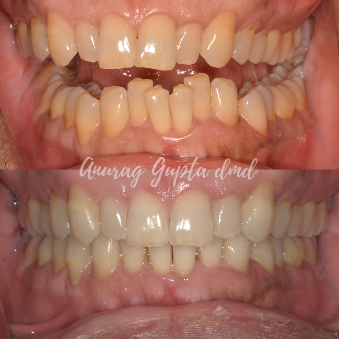 Clear aligner therapy