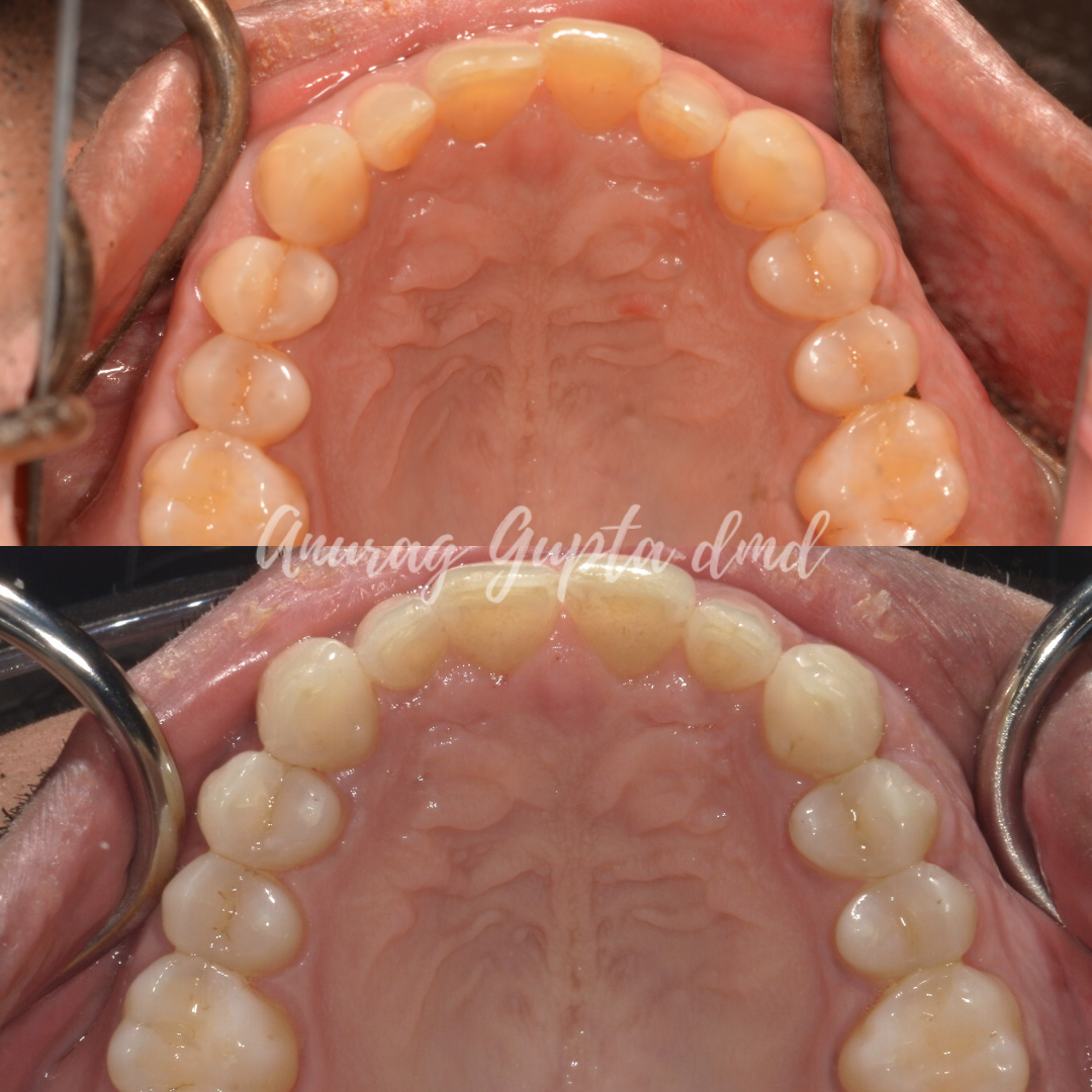 Clear aligner therapy