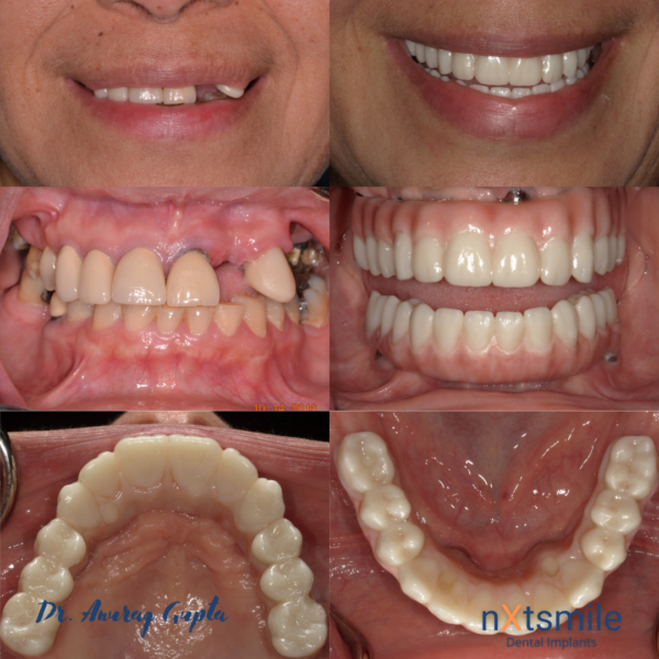 patient with a smile restoration
