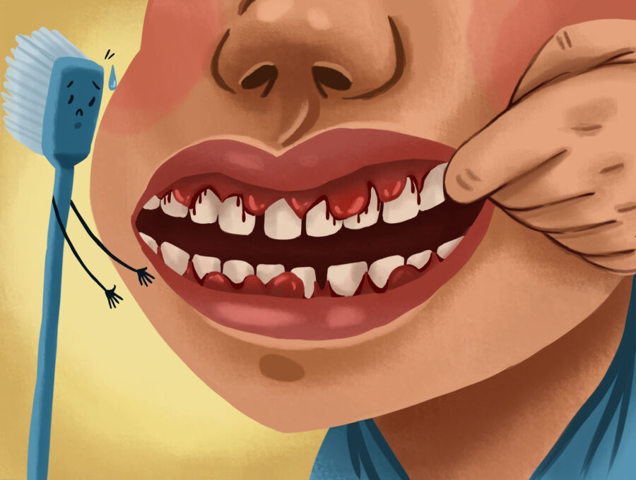Cartoon image of a boy with gum disease, as shown by his swollen and bleeding gums that need improved oral hygiene