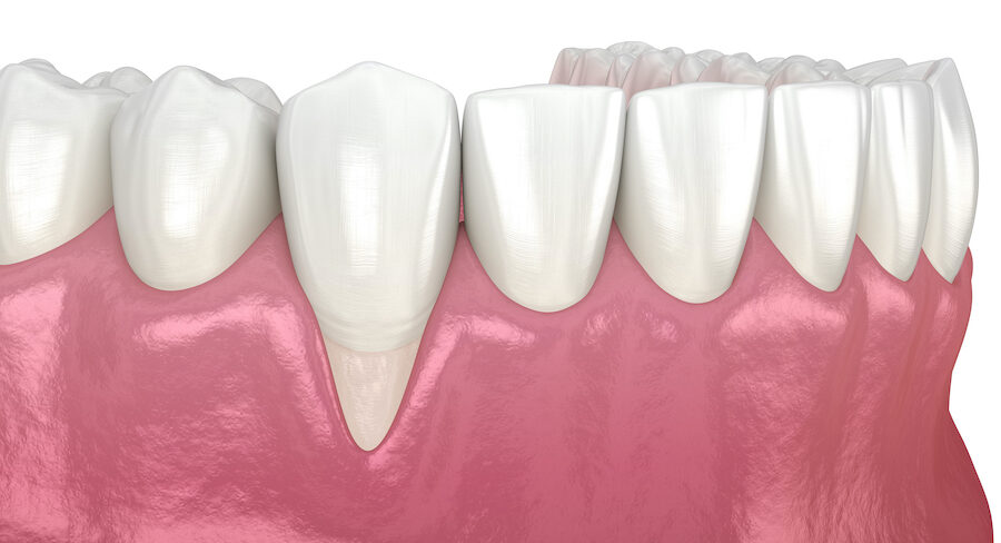 Drawing of gum recession with one tooth with receding gums