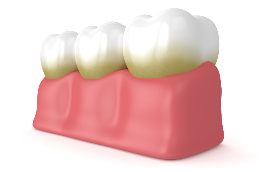 Drawing of 3 teeth with yellow green plaque buildup near the gums