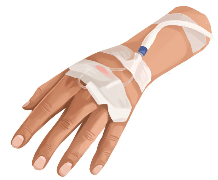 Illustration of a hand with an IV receiving sedation medication during a dental procedure
