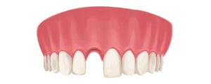 Illustration of upper arch of teeth missing a tooth after an extraction