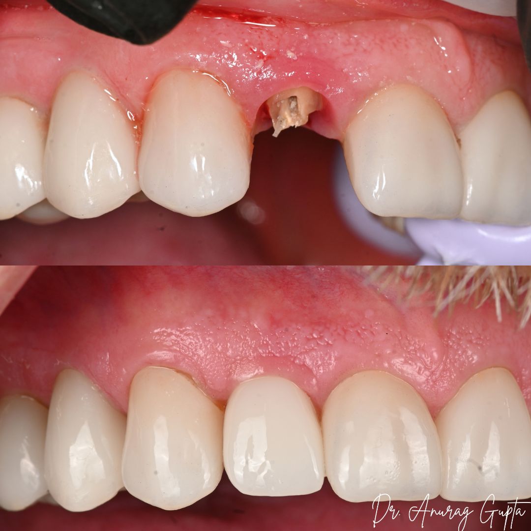 Before and after photos of a single front tooth replaced with an immediate dental implant — Grafton Dental Care, Dr. Anurag Gupta DMD