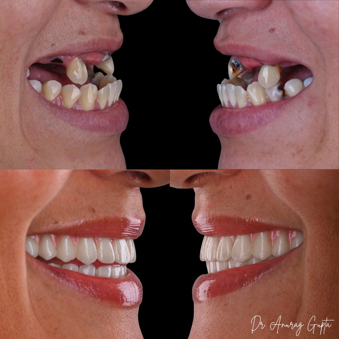 Side profile before and after photos showing bite correction with full-arch dental implants at Grafton Dental Care, Grafton MA — Dr. Anurag Gupta, DMD