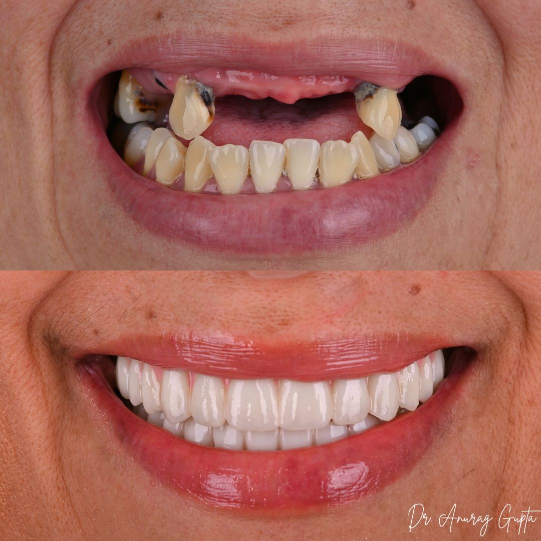 Close-up before and after photos of full-arch dental implant smile reconstruction at Grafton Dental Care, Grafton MA — Dr. Anurag Gupta, DMD